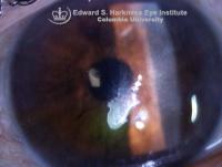 Opalescent corneal intraepithelial neoplasia arising from the temporal superior limbus extended inferiorly involving the central cornea.